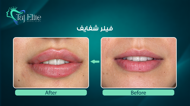 before-^-after18